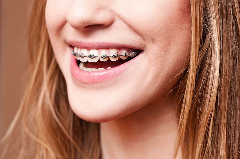 Orthodontics in Jefferson City