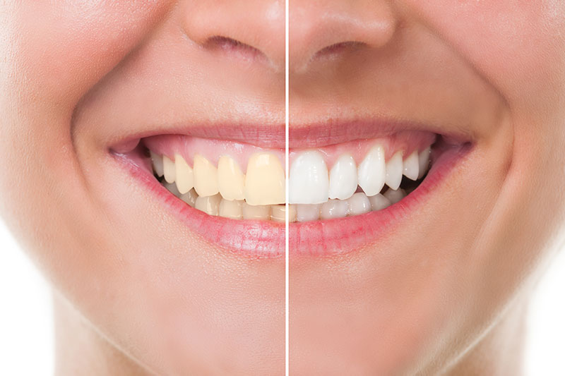 Teeth Whitening in Jefferson City